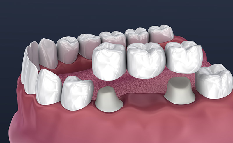 dental bridges in Saskatoon