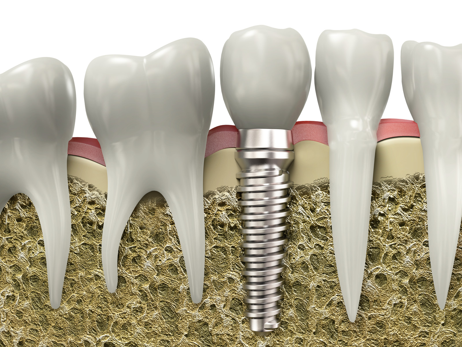 the process of placing a dental implant