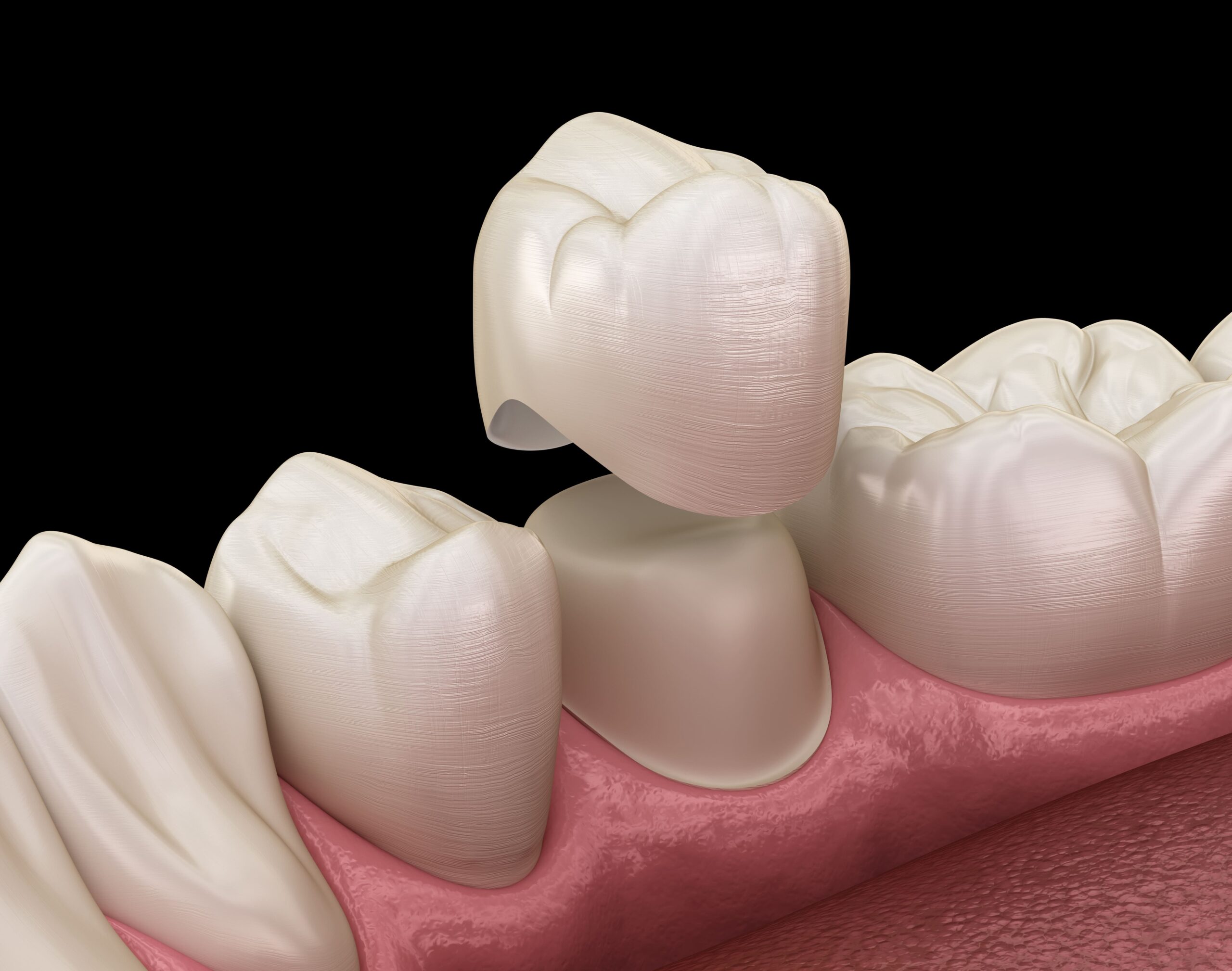 guide to a faster recovery after getting tooth crowns