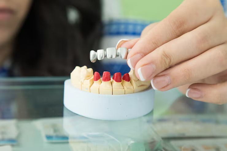 dental-bridge-vs-implant-which-is-the-right-choice-for-you