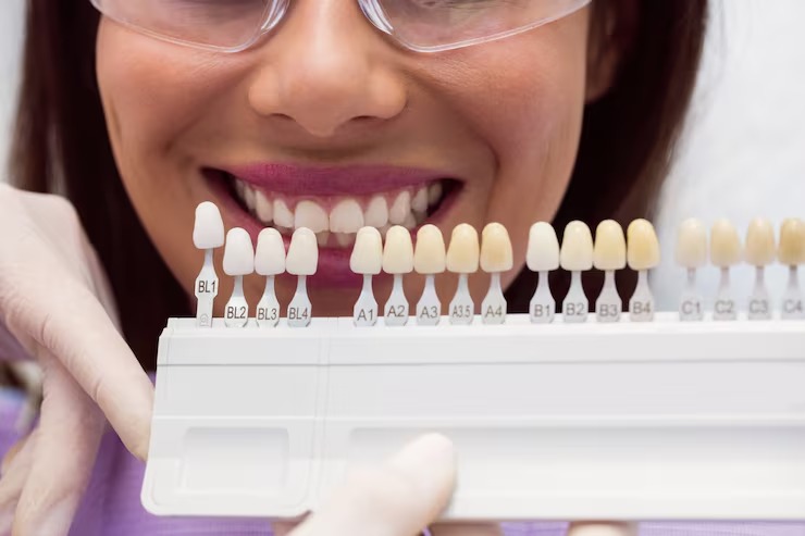 Porcelain veneers vs bonding which is better